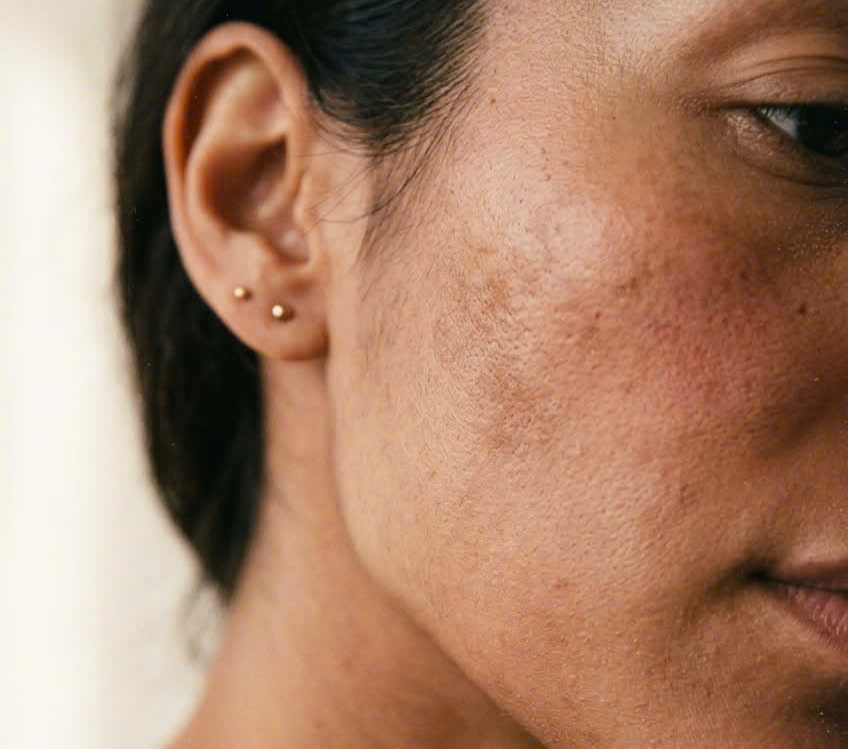 Gently Fade & Help Prevent Melasma: Why Green and Yellow LED Light Are Game-Changers for Your Skin
